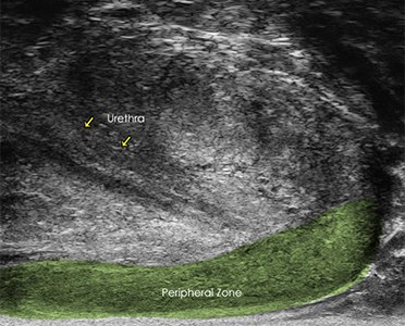 Midline micro-ultrasound view of the prostate with the urethra and the peripheral zone labelled