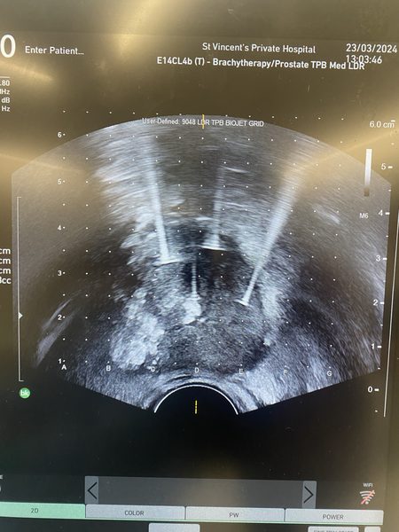NanoKnife needle placement under image guidance