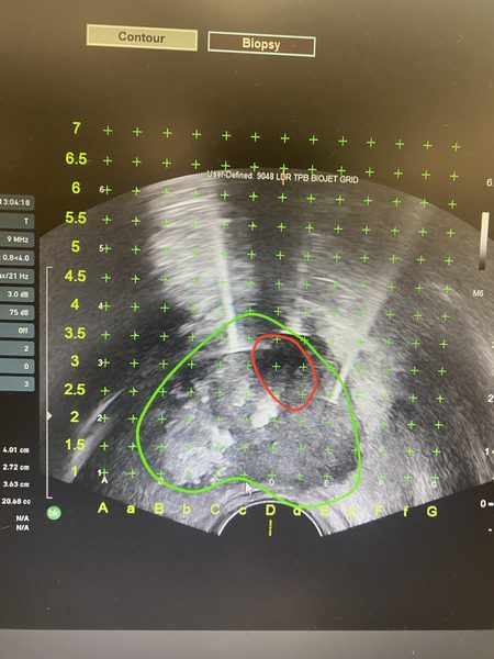 MRI and ultrasound fusion guidance during NanoKnife needle placement
