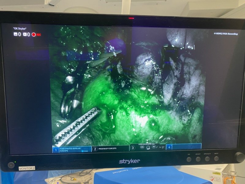 Robotic partial nephrectomy ICG fluorescence view showing renal perfusion