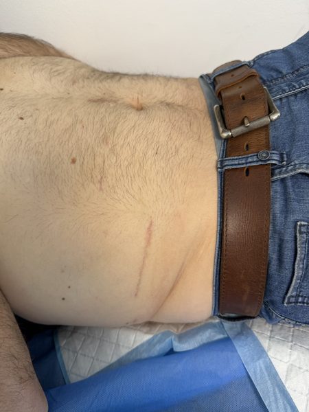 Single-port nephrectomy incision site