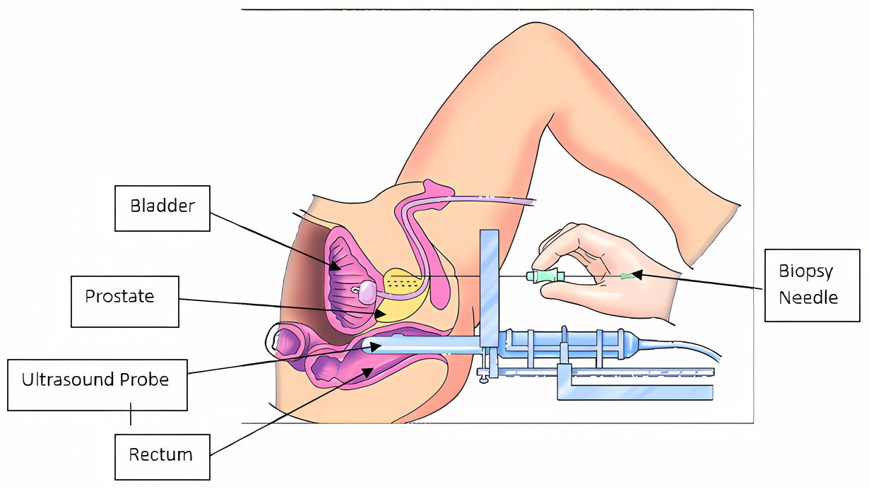 Labelled cross-section diagram of a transperineal prostate biopsy showing the biopsy needle entering through the perineum and the ultrasound probe in the rectum, with the bladder, prostate and rectum labelled.